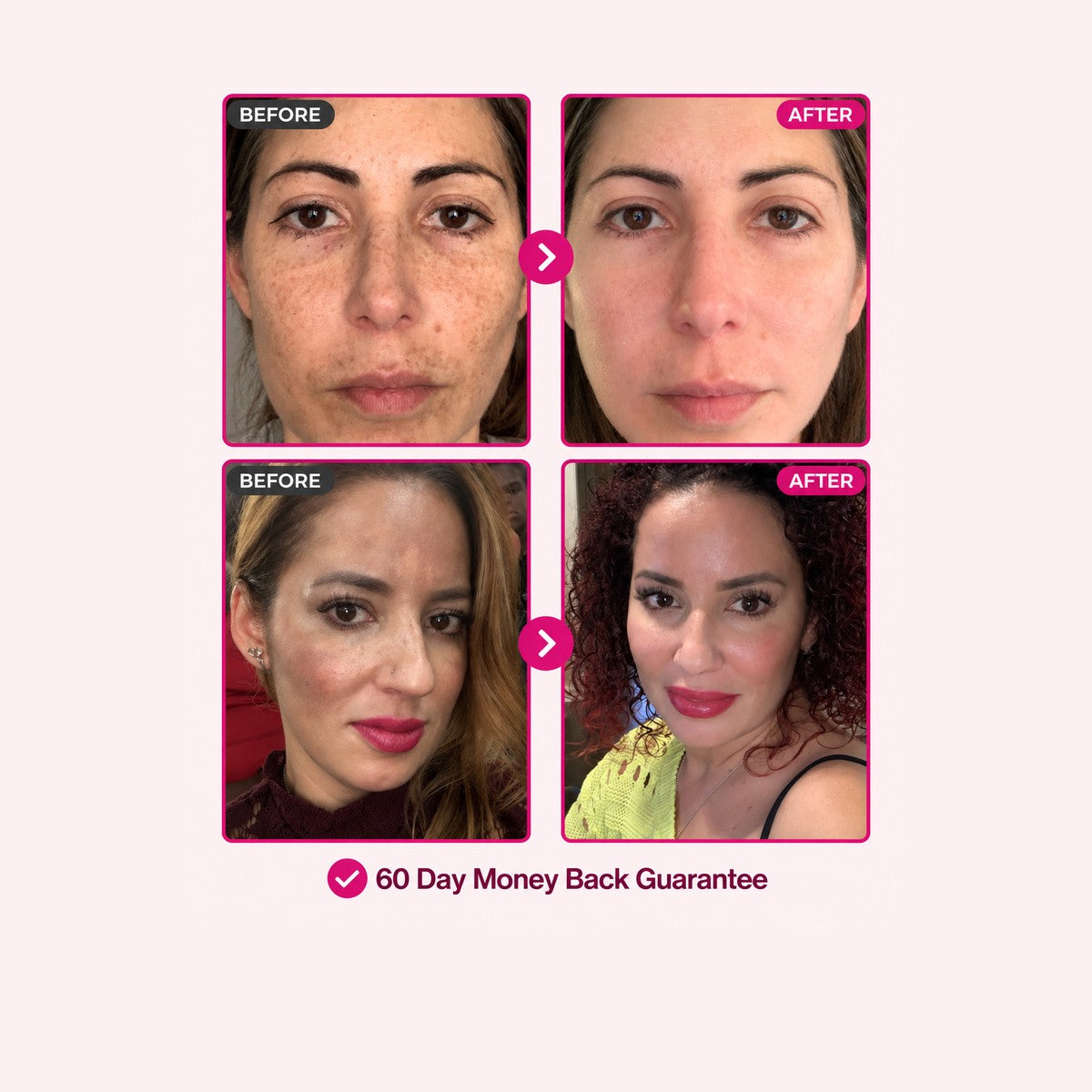 Before and after: melasma faded with LumaBelle