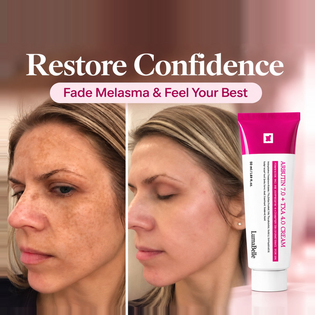 Before and after: fading melasma, more even skin tone