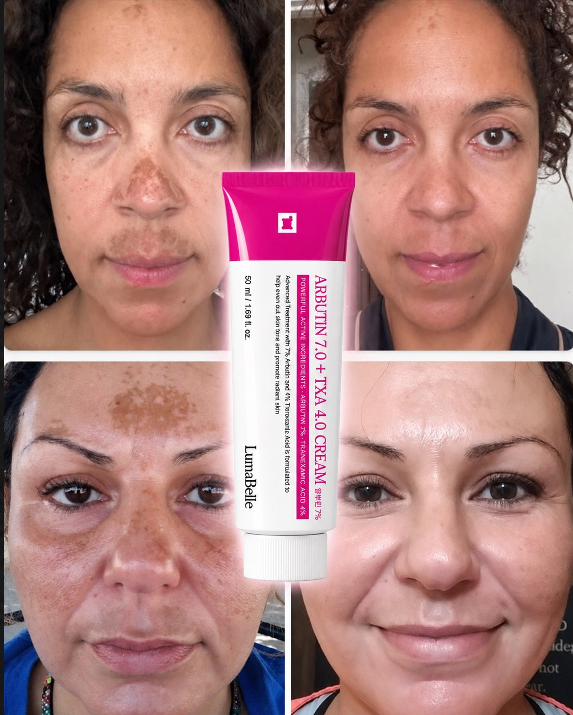 LumaBelle before and after: melasma faded