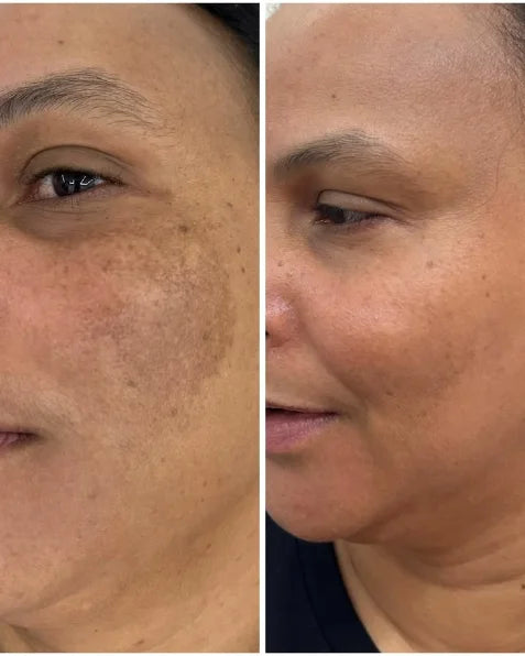 Sugey H. melasma before and after
