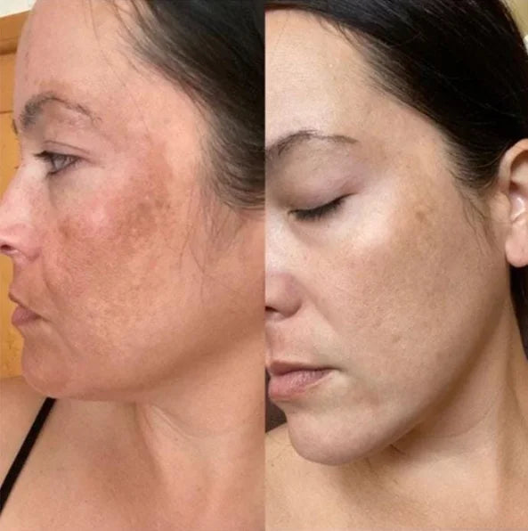 Leeah melasma before and after
