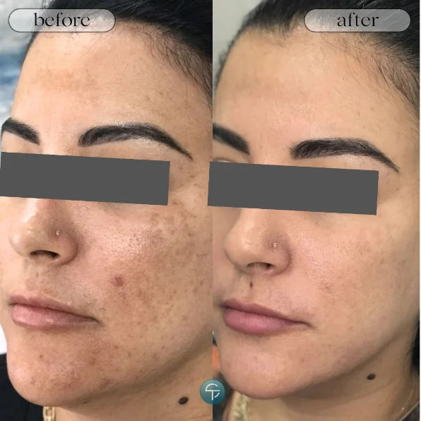 Claudia B. melasma before and after