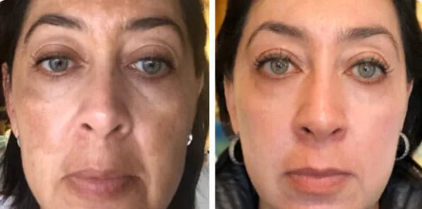 Alexis M. melasma before and after